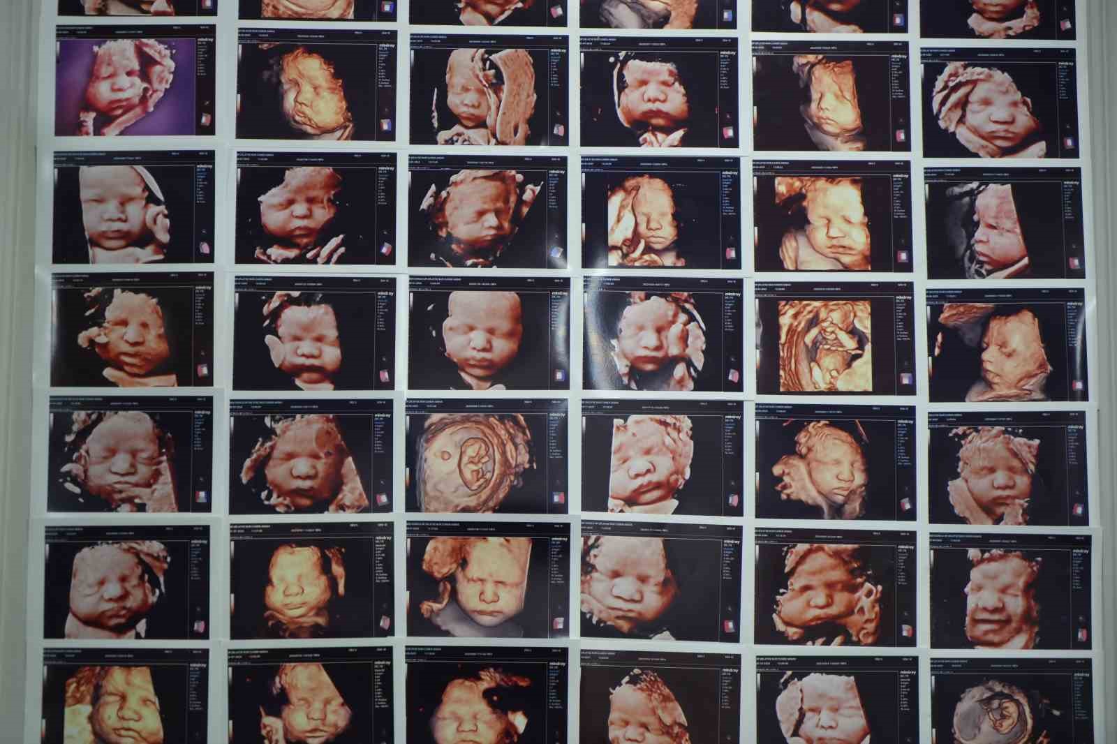 7 yıllık bebek hasreti "kişiye özel" tedaviyle son buldu

