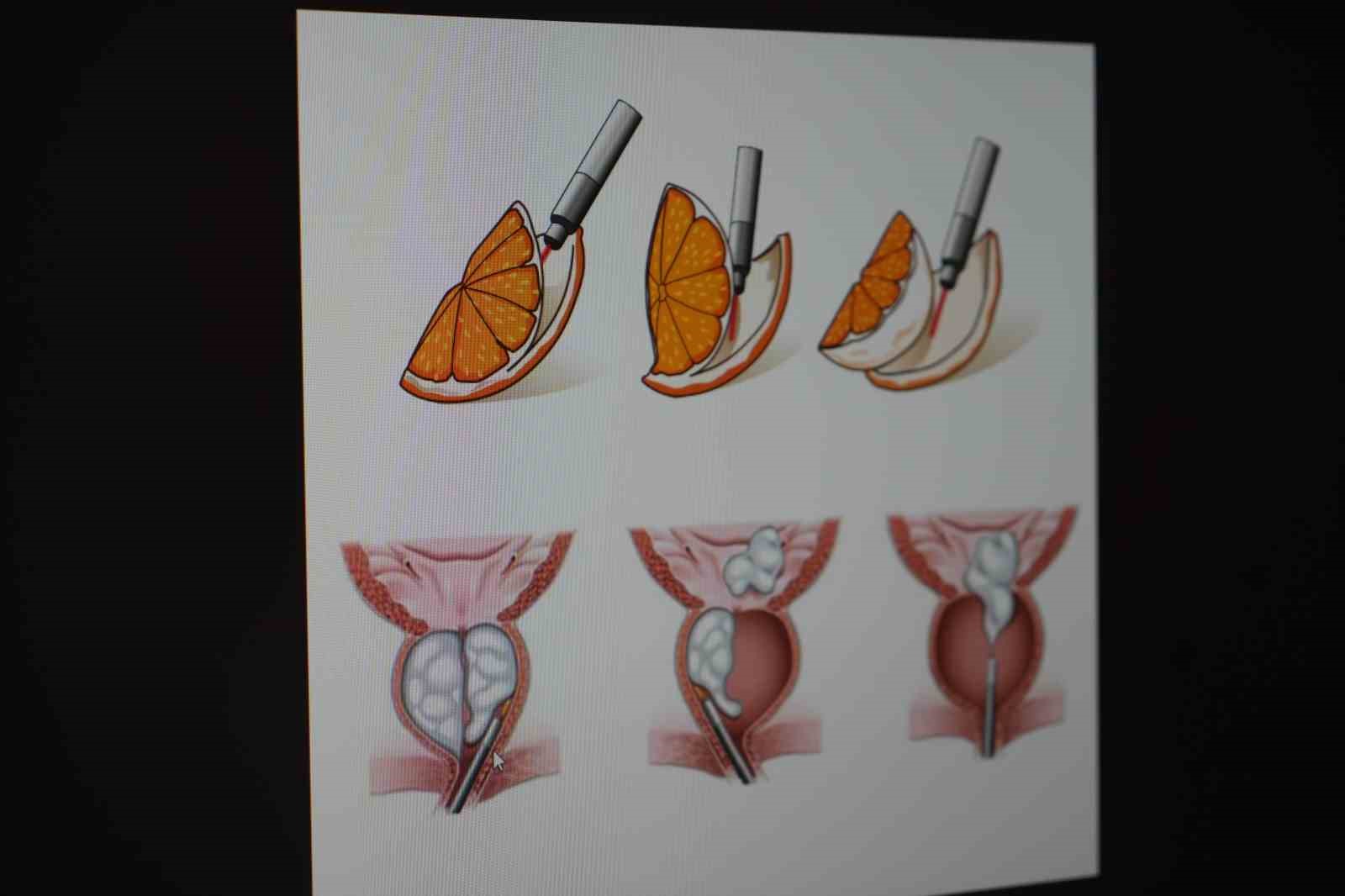 Erkeklerde sinsi tehlike çoğu zaman belirti vermiyor
